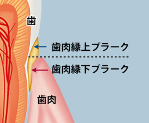 歯肉縁上プラークと歯肉縁下プラーク