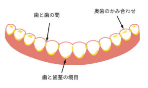 プラークがつきやすいところ