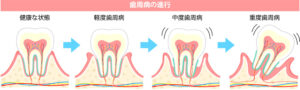 歯周病の進行