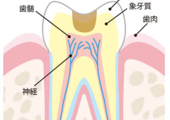 進行した虫歯