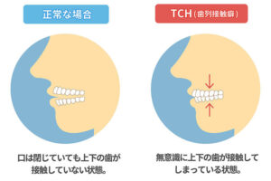 TCHとは