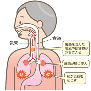 誤嚥性肺炎