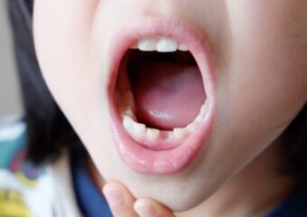 歯の生え変わり