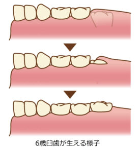6歳臼歯が生える様子