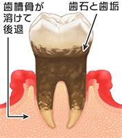 歯周病の進行3