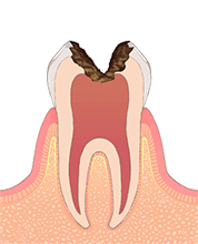 虫歯の進行3